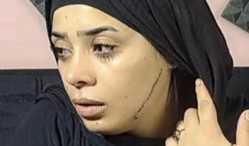 محاكمة المتهمة بتشويه وجه عروس طليقها